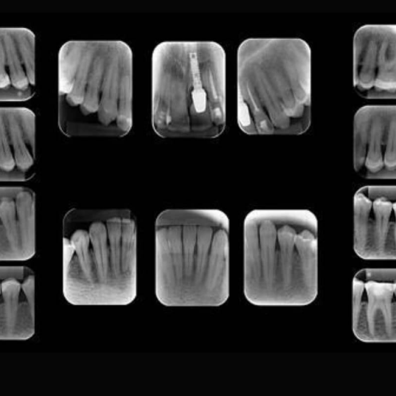 periapical-radiografia