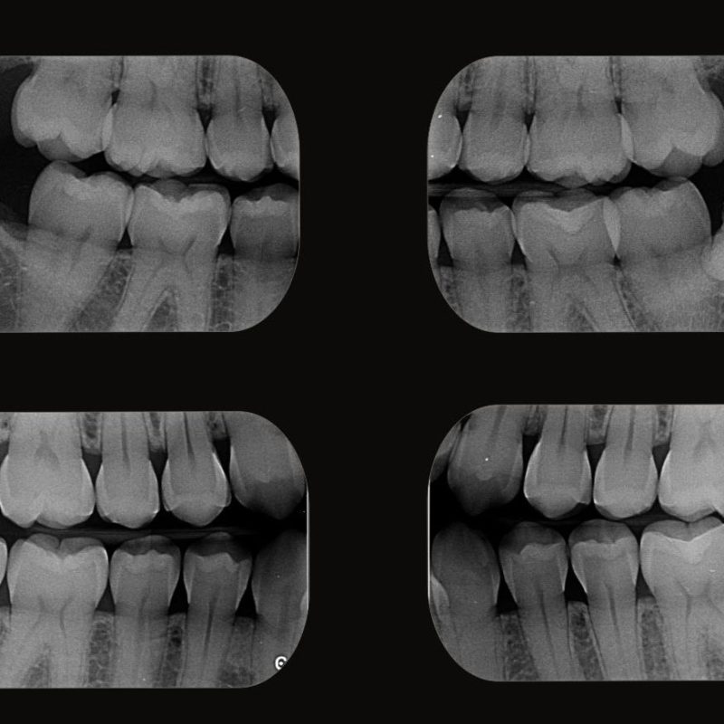 radiografia-interproximal
